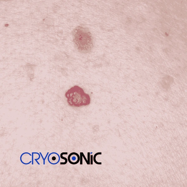 Looking for pain free cherry angioma removal treatment Featherstone? Call our team today! Featherstone