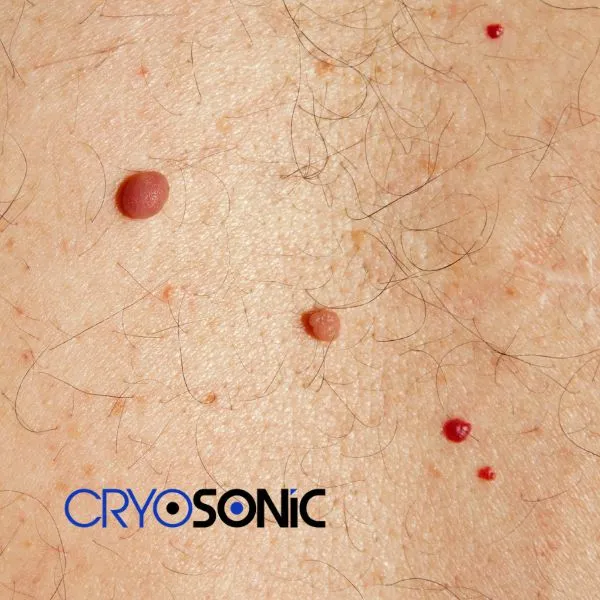 get cherry angioma removal treatment today! Featherstone