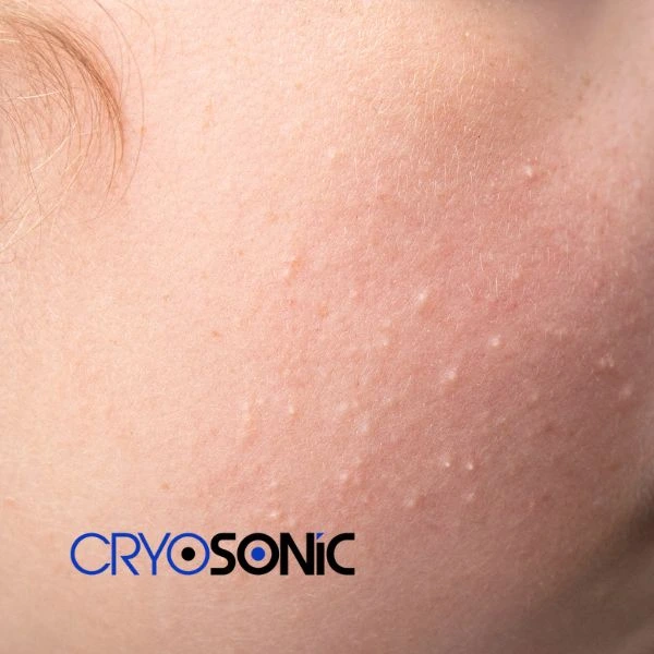 Are you looking for milia removal treatment? Contact our team today Featherstone