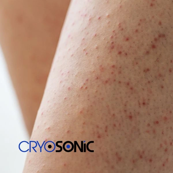 Looking for Seborrhoeic Keratosis removal Featherstone treatment? Call our consultants today in Featherstone