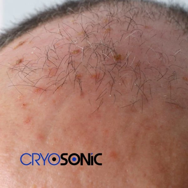 Access Seborrhoeic Keratosis removal from the comfort of your own home! Call us today in Featherstone