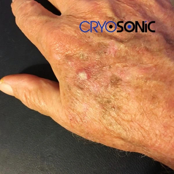 Understand more about actinic keratosis treatment today Featherstone