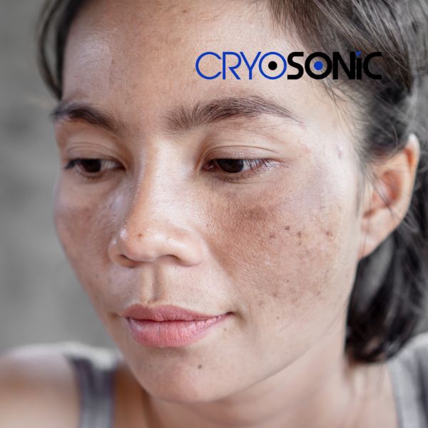 Ready to start age spots removal? Contact our team today in Featherstone