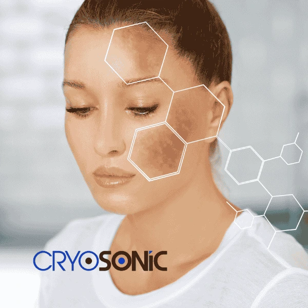 Are you looking for age spot removal treatment? Contact Cryosonic today in Featherstone