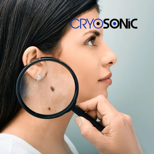 Do you want to learn more about benign moles removal treatment? Call our team today Featherstone