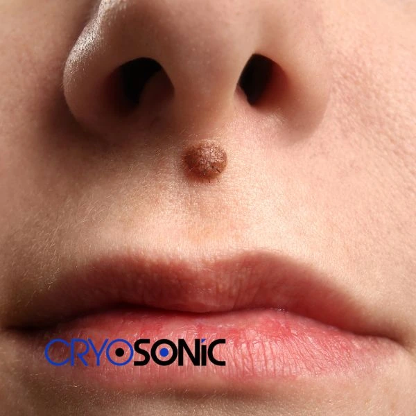 Start your benign moles removal treatment today Featherstone