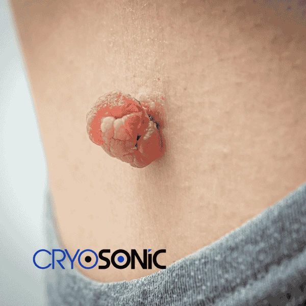 Book your skin tags removal Featherstone from comfort of your own home! Featherstone
