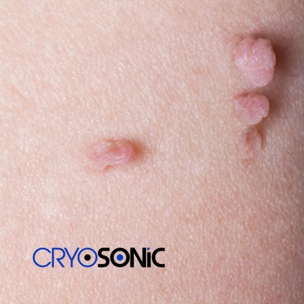 Are you looking for fast effect skin tag removal Featherstone? Book in NOW! Featherstone