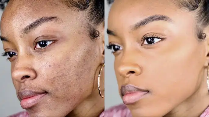 FAQs About Cryotherapy for Darker Skin Featherstone