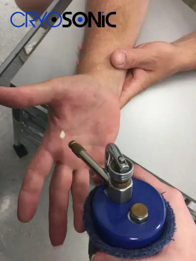 Temperature Differences: OTC vs Medical-Grade Cryotherapy Featherstone